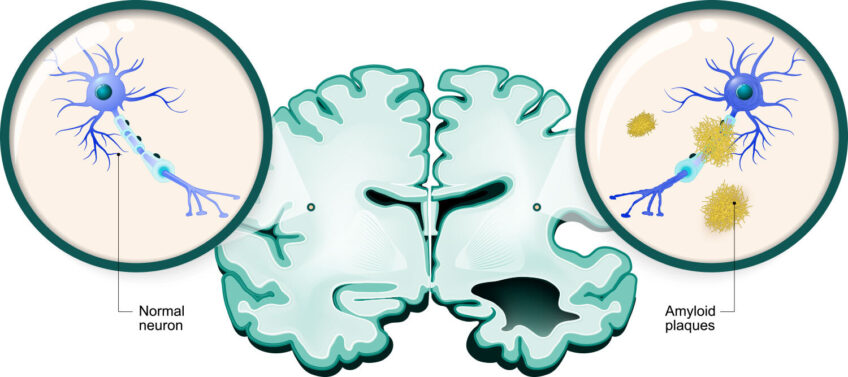 amyloid plaque